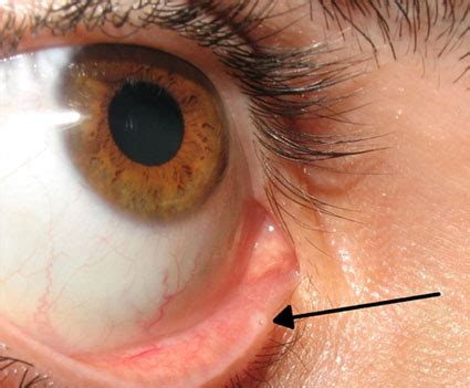 Lacrimal - Dr. Amin Nasr - Plastic & Eye Surgery in Lebanon