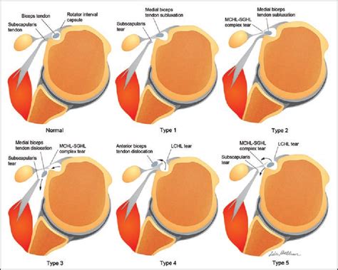 Figure 7 from The rotator interval: a review of anatomy, function, and normal and abnormal MRI ...