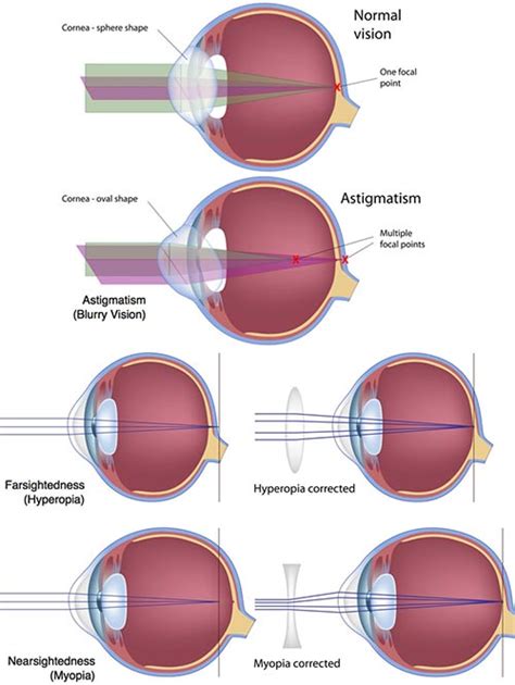 Types of LASIK Eye Surgery · Top Rated Doctor · NYC Ophthalmologist