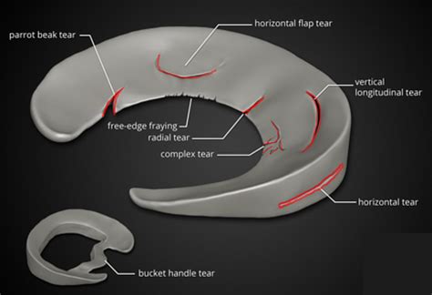 Meniscus Tear Recovery? Newer Techniques May Help!