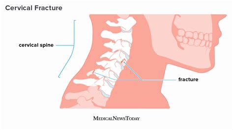 Broken neck: Treatment and recovery