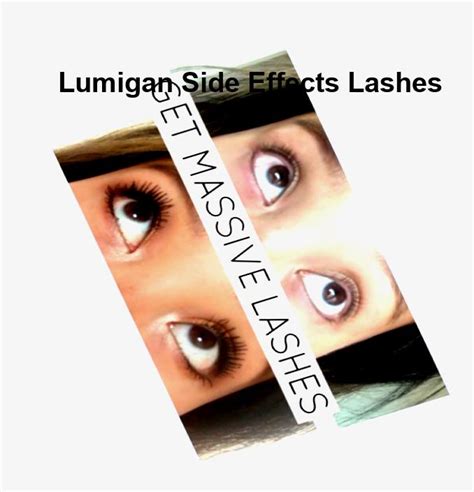 Lumigan side effects lashes, lumigan eye drops for eyelashes uk – | SPINNINGREELCENTER