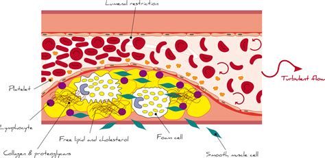 Atherosclerosis and atheroma – Pathologia