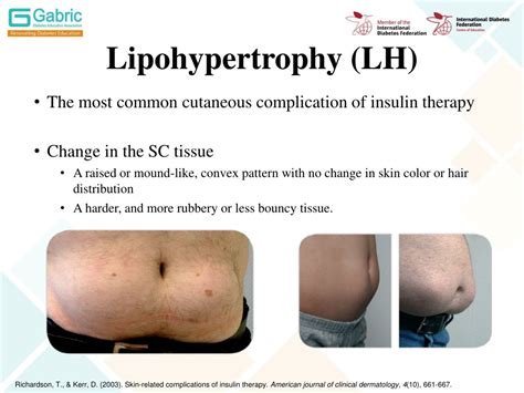 PPT - Insulin Injection: Guidelines and Practical Aspects PowerPoint Presentation - ID:474676