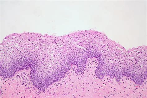 Gartner Duct Cyst Histology