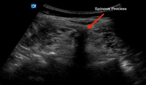 Ultrasound-Guided Lumbar Puncture – St. Joseph's Health Center: Emergency Medicine Residency Blog