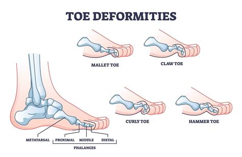 Mallet Toe Advice: Hammer Toe vs Mallet Toe Explained