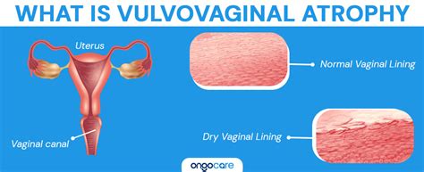 Vulvovaginal Atrophy: Causes, Symptoms, Treatment - Ongo Care