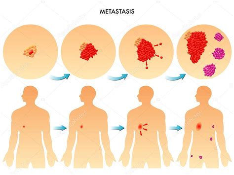 Colorful Metastasis scheme — Stock Vector © rob3000 #73928443