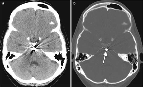 Computed Tomography | Radiology Key