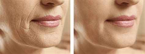 Before & After Laser Treatment for Wrinkles Photo Gallery | The Spa at Spring Ridge