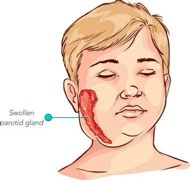 Parotitis Introduction, Symptoms, Causes and Treatments - My Blog