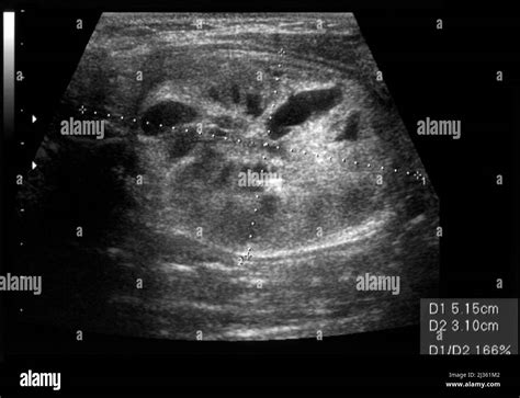 Thyroid nodule, ultrasound scan Stock Photo - Alamy