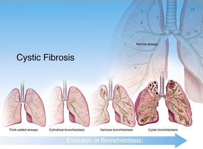 Elaine Kurie: Cystic Fibrosis Stages – Artists' Blogs :: Medical Illustration Sourcebook