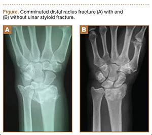 Concomitant Ulnar Styloid Fracture and Distal Radius Fracture Portend ...