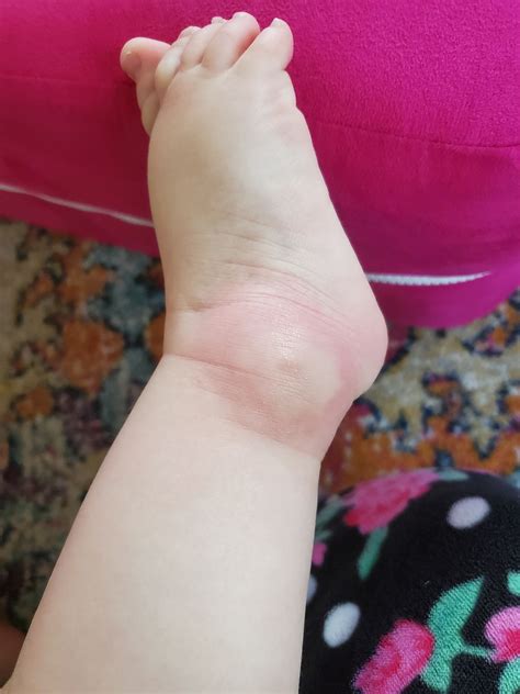 Huge mosquito bite.. Cause for concern or normal reaction? | BabyCenter