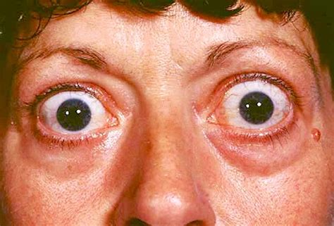 exophthalmos | Common eye diseases, Hyperthyroidism, Eye diseases