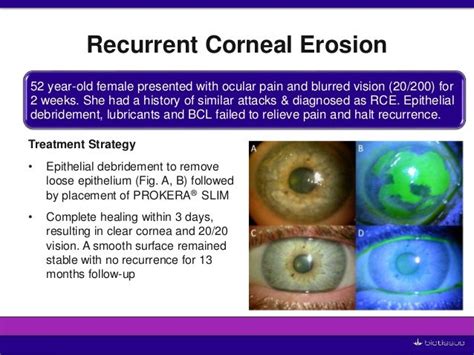 New Technologies for Successfully Managing Ocular Surface Inflammat…