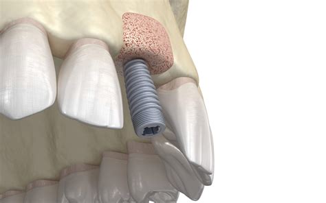 What Is Bone Grafting For Dental Implants | Voss Dental - Oral Surgery | Implant