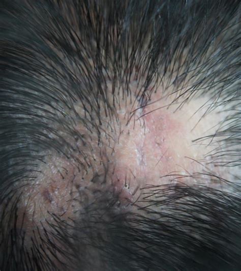 Scarring Alopecia – Types, Causes, Symptoms, And Treatments