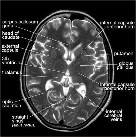 Mri Anatomy Of Brain Anatomy Drawing Diagram | My XXX Hot Girl