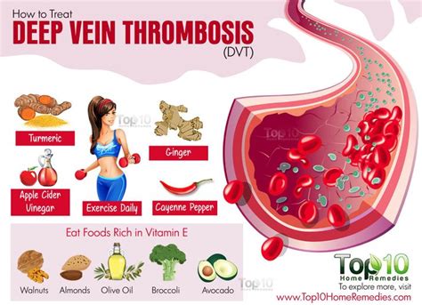 17 Best images about Deep Vein Thrombosis on Pinterest | Shops, Medical ...