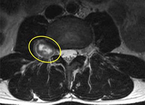 Spinal Tumor Treatment & Removal | Swift Institute