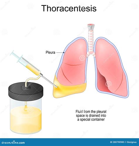 Thoracentesis. Thoracocentesis is an Invasive Medical Procedure Stock ...