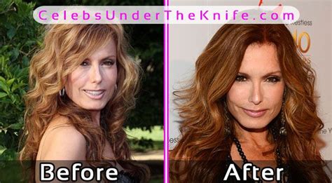 Tracey Bregman Surgery Photos Before After