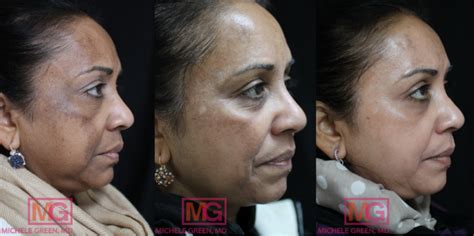 Post Laser Hyperpigmentation - Melasma & dark skin