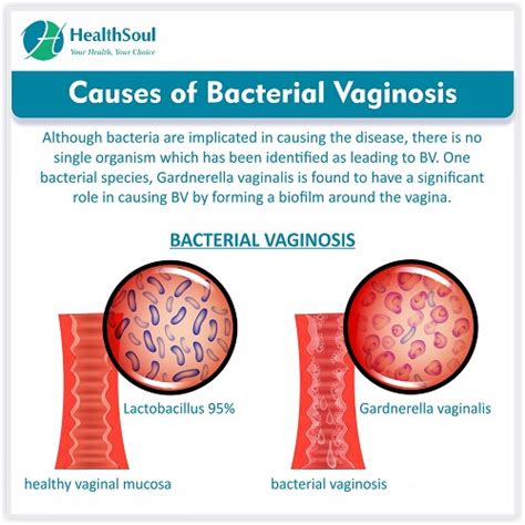 Bacterial Vaginosis: Causes, Symptoms and Treatment - Healthsoul