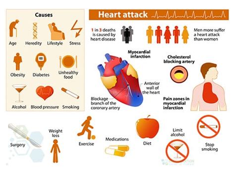 UC-MSC+ Cardiopoietic Stem Cell Therapy After Heart Attacks - MI