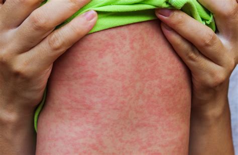 Warning issued as four cases of measles are reported in Dublin