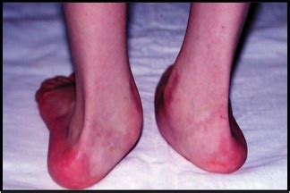 Equinovalgus Foot - Pediatrics - Orthobullets