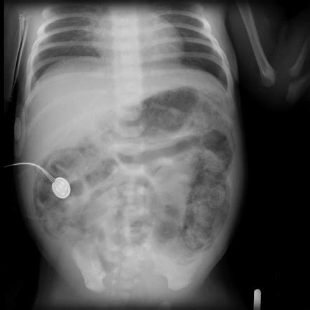 Necrotizing Enterocolitis Ultrasound