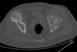 Myositis Ossificans - Sumer's Radiology Blog