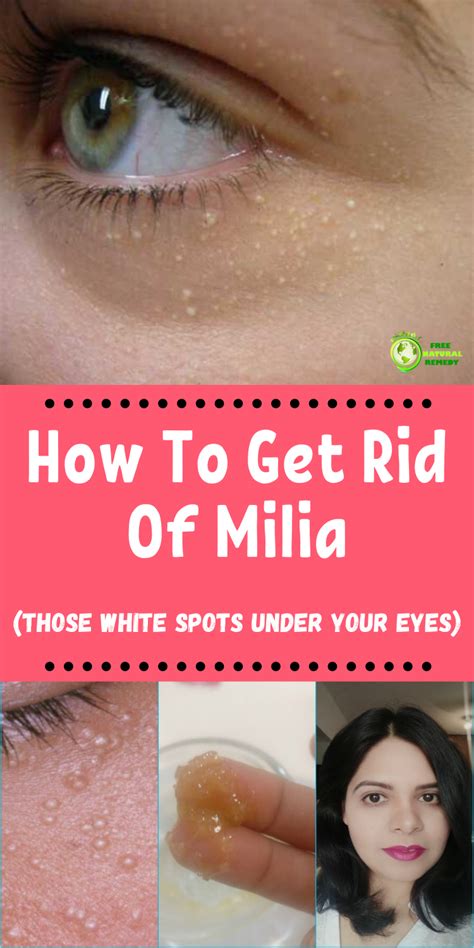 How To Get Rid Of Milia (Those White Spots Under Your Eyes)! | Home remedies for skin, Skin ...