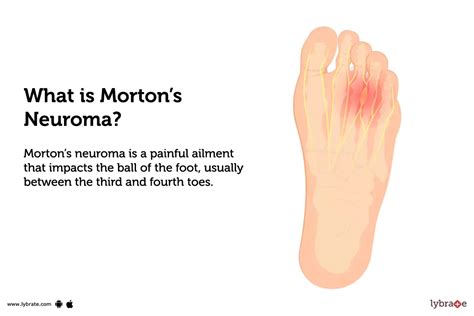 Morton's Neuroma: Causes, Symptoms, Treatment and Cost