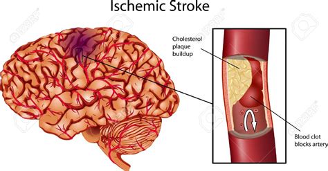 ISCHEMIC STROKE is caused by blocked artery in the