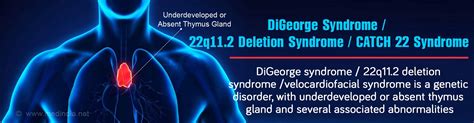 DiGeorge Syndrome - Causes, Symptoms, Diagnosis, Treatment & Prognosis