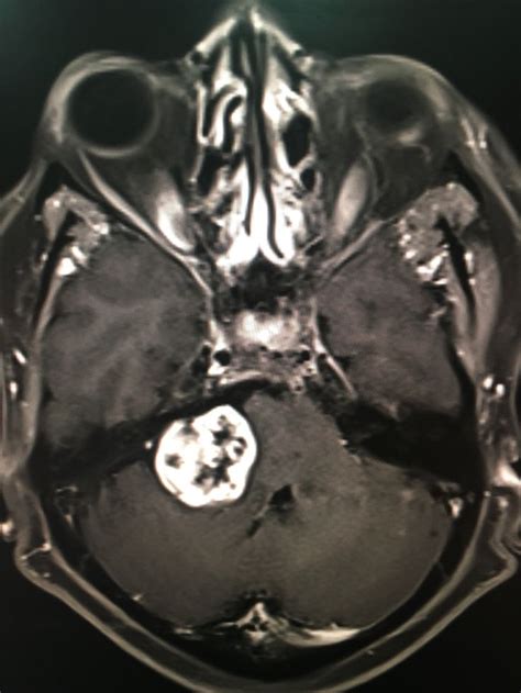 Acoustic neuroma | Radiology imaging, Radiology, Human anatomy and ...