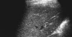 Ultrasound images Granuloma - Radiology Imaging