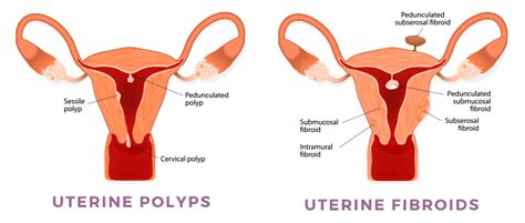 What Is Uterine Polyp Removal Called