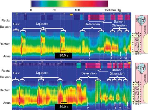 Normal Values for High-Resolution Anorectal Manometry in Healthy Women: Effects of Age and ...