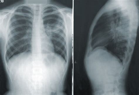 Can Chest X-Rays Predict Covid-19?