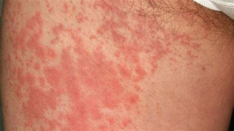 Anemia Rash: Causes, Pictures, and Treatment