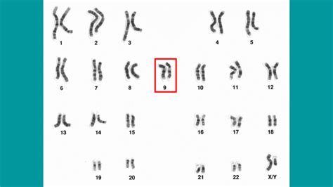 What is Tetrasomy 9p? What are the ways for prenatal diagnosis?