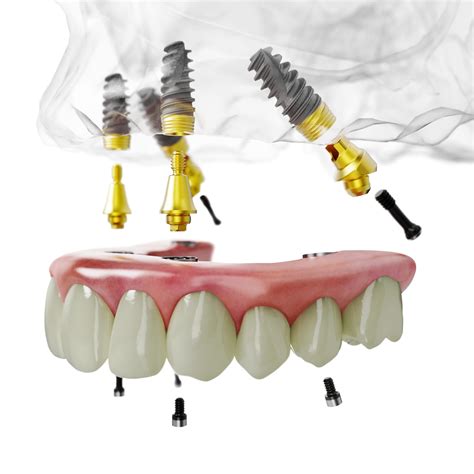 All About the Innovative All-on-4 Dental Implant Procedure