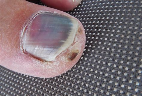 photos of melanoma under toenail | Symptoms and pictures