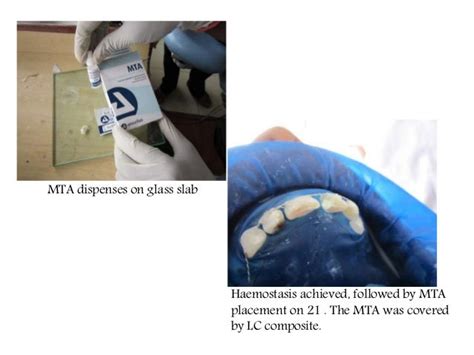 A case of cvek pulpotomy with mta